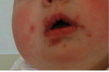 Gesicht eines von Borkenflechte Betroffenen Säuglings.